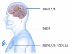 國內首款,腦虎科技硬膜下植入式柔性腦機接口進入“綠色通道”
